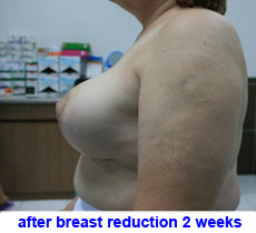 plastic-surgery-breast-reduction