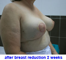 plastic-surgery-breast-reduction