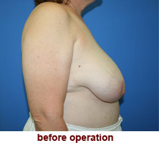 plastic-surgery-breast-reduction