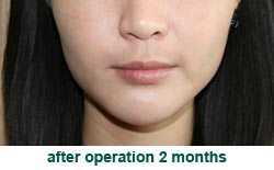 plastic-surgery-chin-augmentation