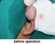 plastic-surgery-keloid-excision