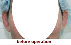 plastic-surgery-otoplasty 