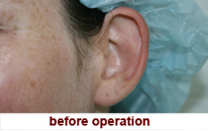plastic-surgery-prominent-ear 